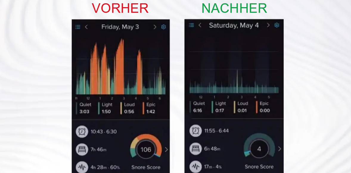 Derila sleep apnea 2 before after C SM DE