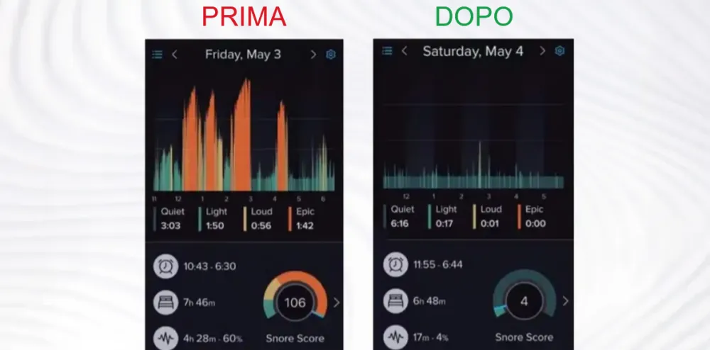 Derila sleep apnea 2 before after C SM IT